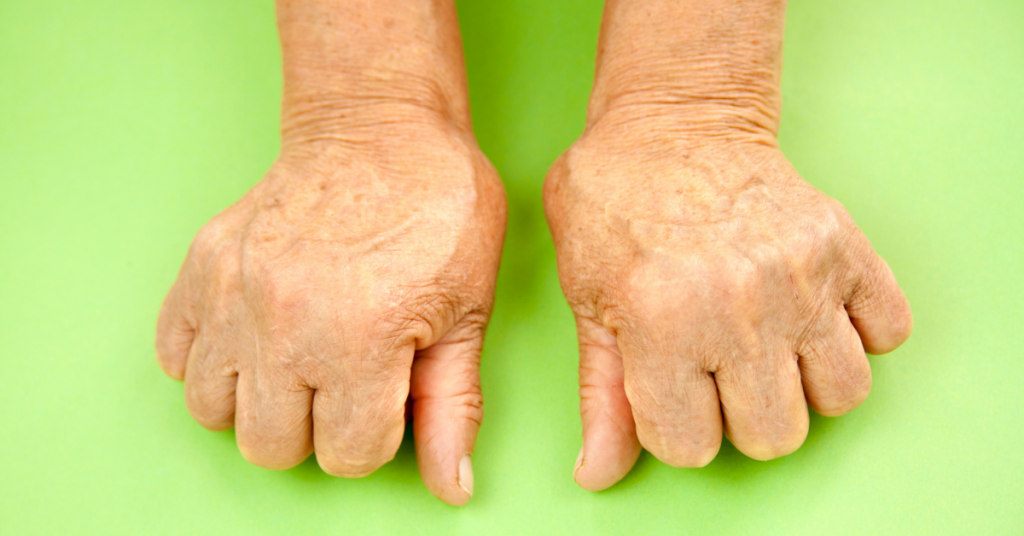 The rarity of contracting still's disease Sri Ramakrishna Hospital