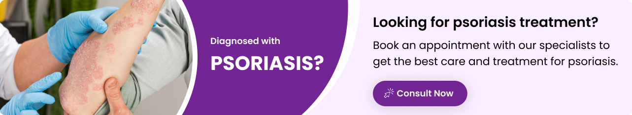 Treatment for psoriasis - Sriramakrishnahospital