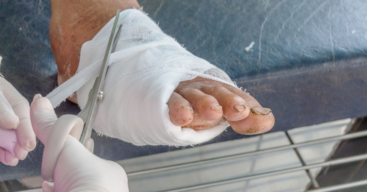 Diabetic Foot Ulcer - Sri Ramakrishna Hospital