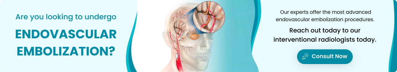 Endovascular Embolization - Sriramakrishnahospital