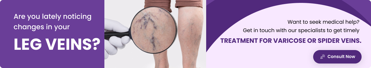 spider veins and varicose veins - Sriramakrishnahospital