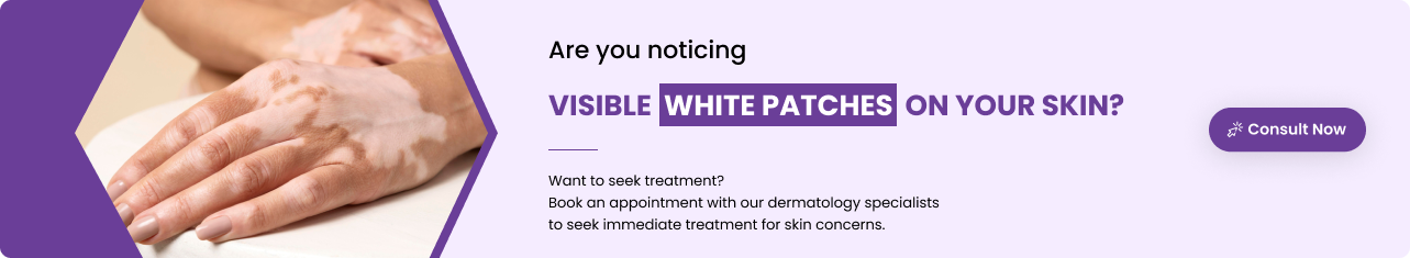 Treatments for vitiligo - Sriramakrishnahospital