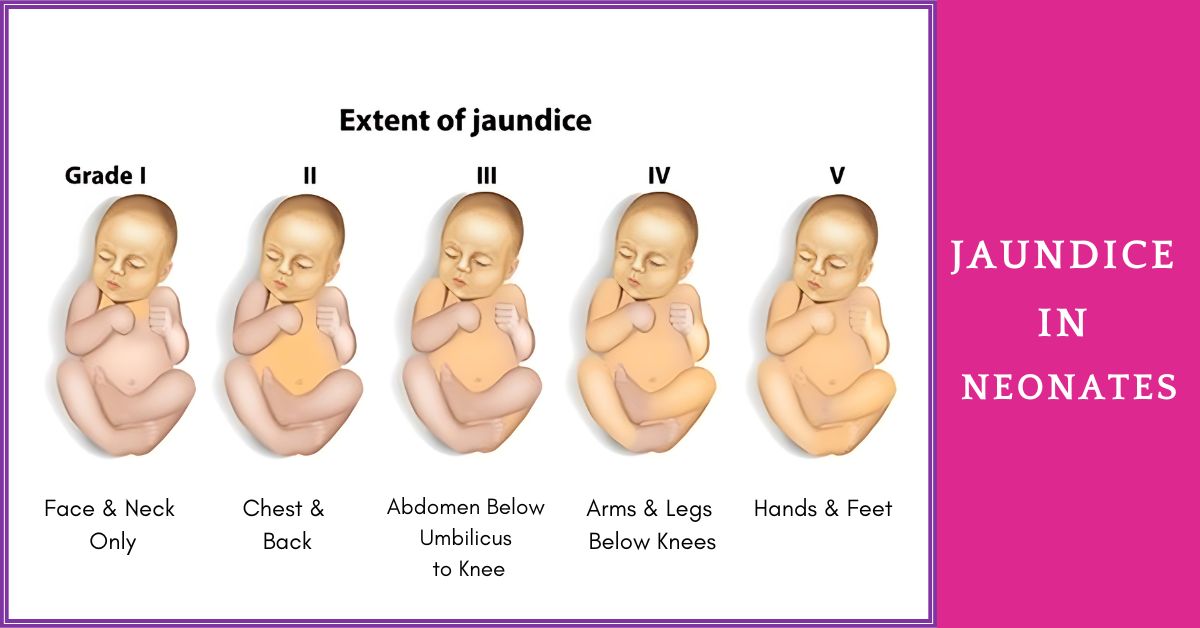 Why Are Newborns Prone To Jaundice Sri Ramakrishna Hospital why-are-newborns-prone-to-jaundice-sri-ramakrishna-hospital