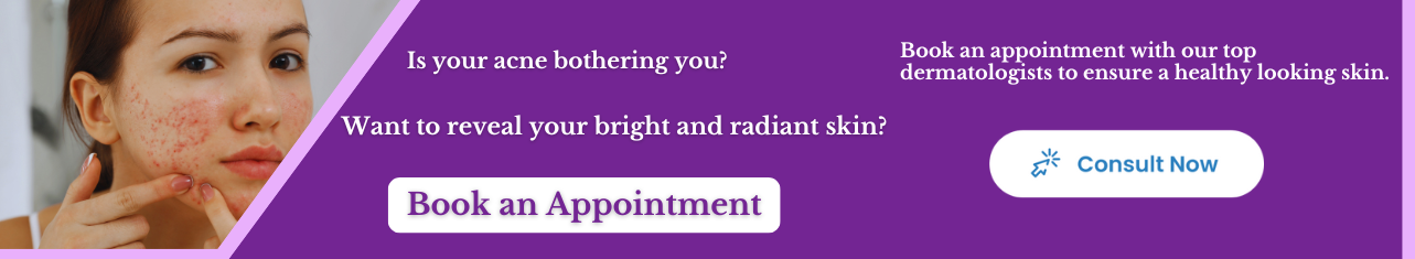 9 Ways to Keep Acne at Bay-Sriramakrishnahospital