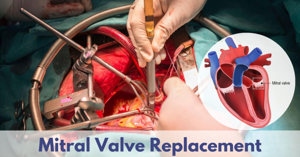 What Symptoms Indicate The Need For Mitral Valve Replacement Sri