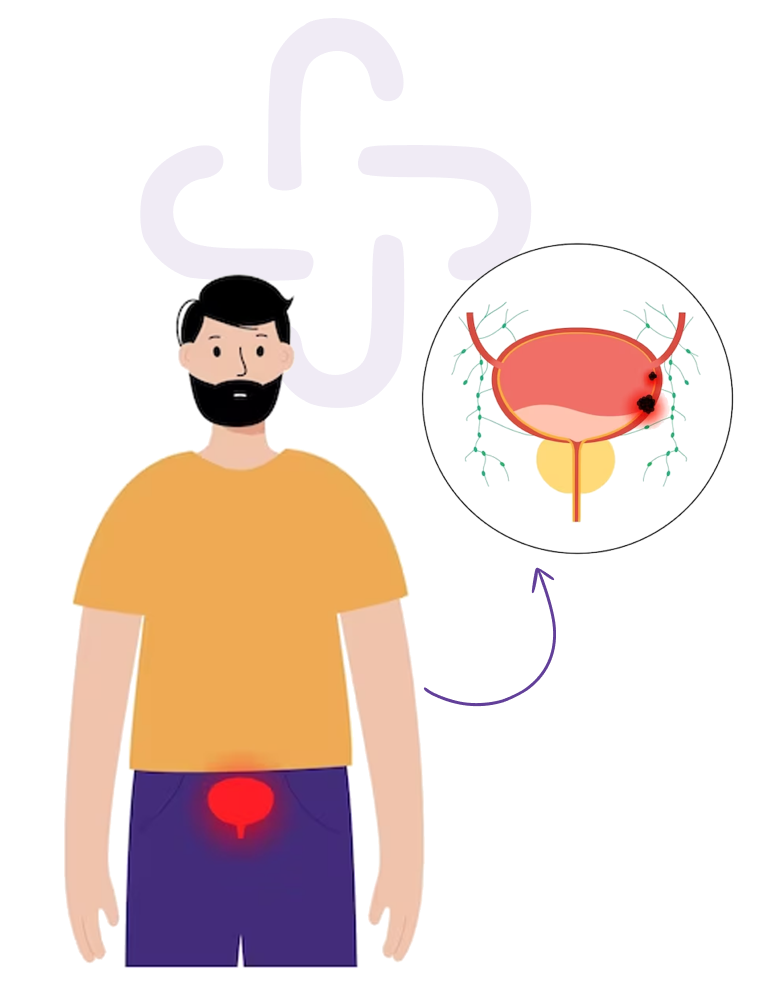 Bladder Cancer Treatment Bladder Cancer Hospital In Coimbatore