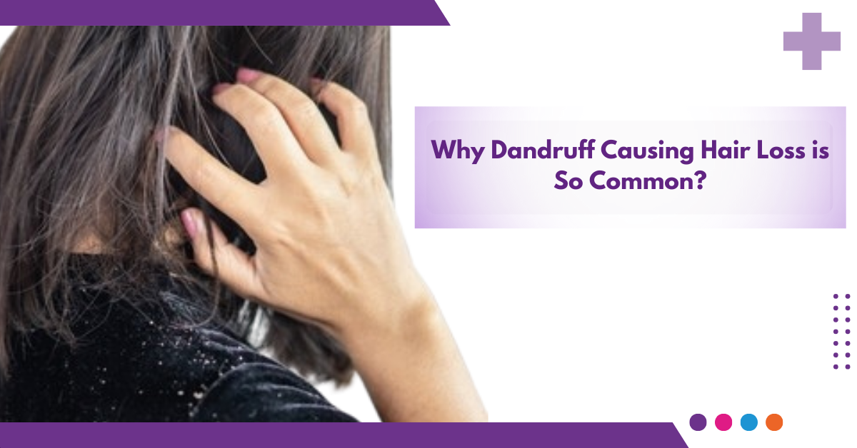 Why Dandruff Causing Hair Loss is So Common?