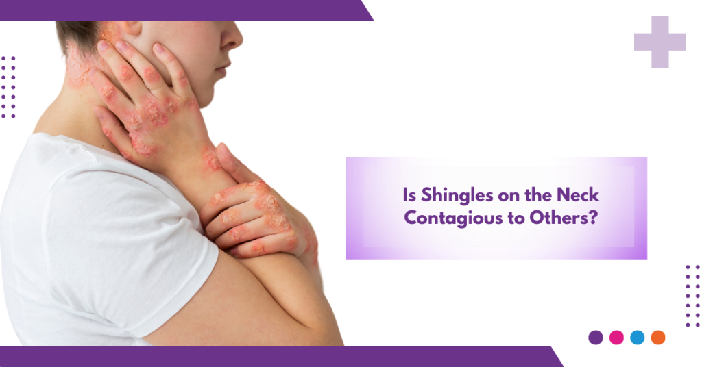 Is Shingles on the Neck Contagious to Others?