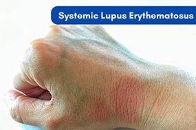 Lupus Treatment in Coimbatore