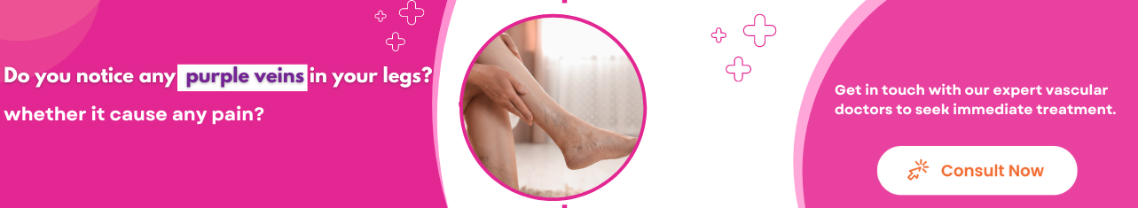 spider veins - Sriramakrishnahospital
