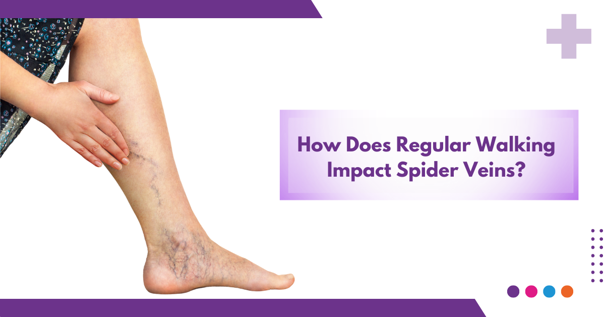 How Does Regular Walking Impact Spider Veins?