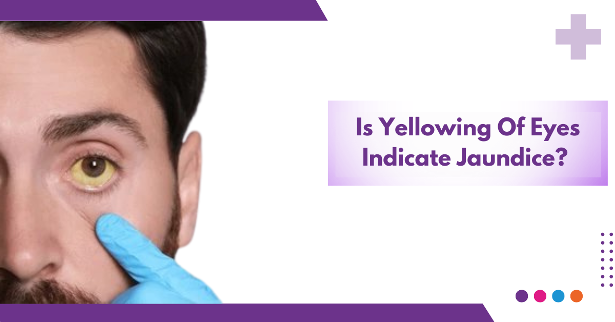 Is Yellowing Of Eyes Indicate Jaundice?
