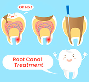 Root canal treatment in coimbatore - Sri Ramakrishna Hospital