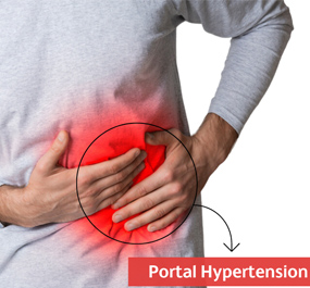 Portal Hypertension treatment in Coimbatore