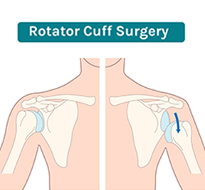 Rotator Cuff Injury Treatment in Coimbatore