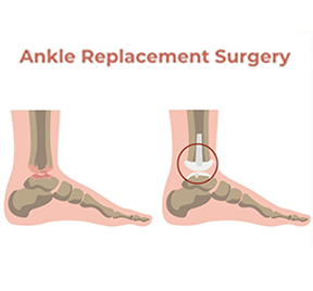 Ankle Arthritis Treatment - Sri Ramakrishna Hospital