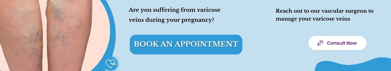 Varicose veins Treatment