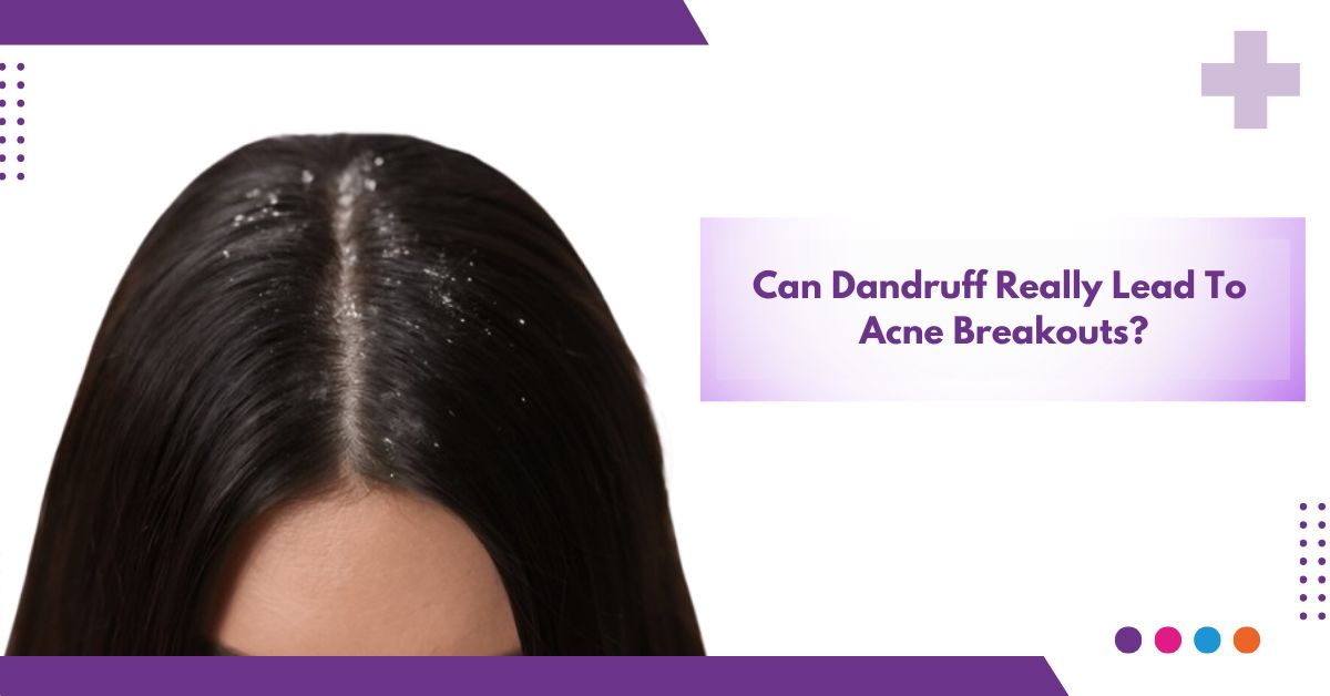 Can Dandruff Really Lead To Acne Breakouts ?