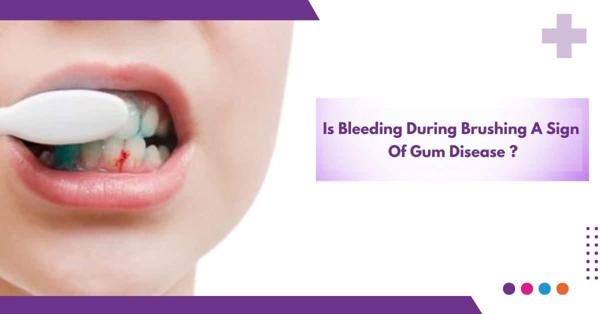 Is Bleeding During Brushing A Sign Of Gum Disease ?
