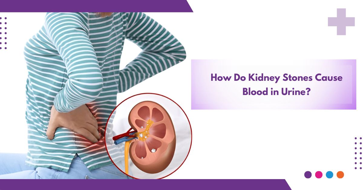 How Do Kidney Stones Cause Blood in Urine ?