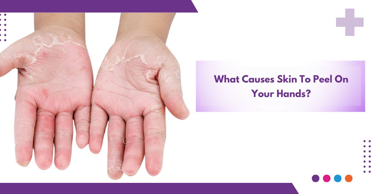 What Causes Skin to Peel on Your Hands ?
