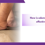 How Is Edema Treated Effectively?