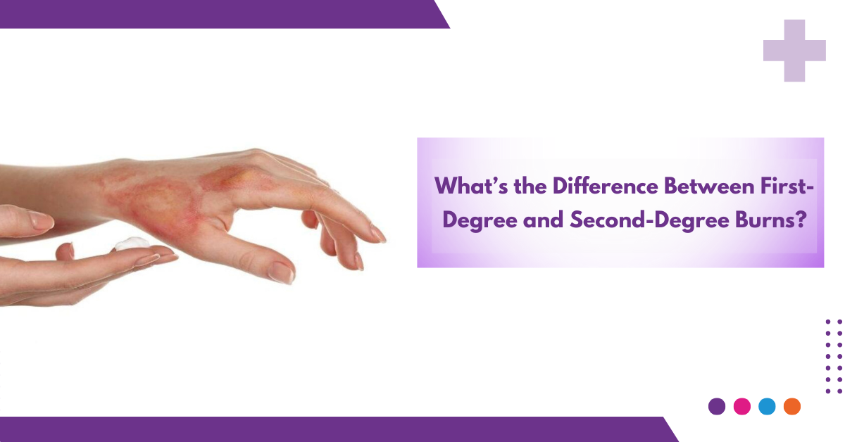 What’s the Difference Between First-Degree and Second-Degree Burns?