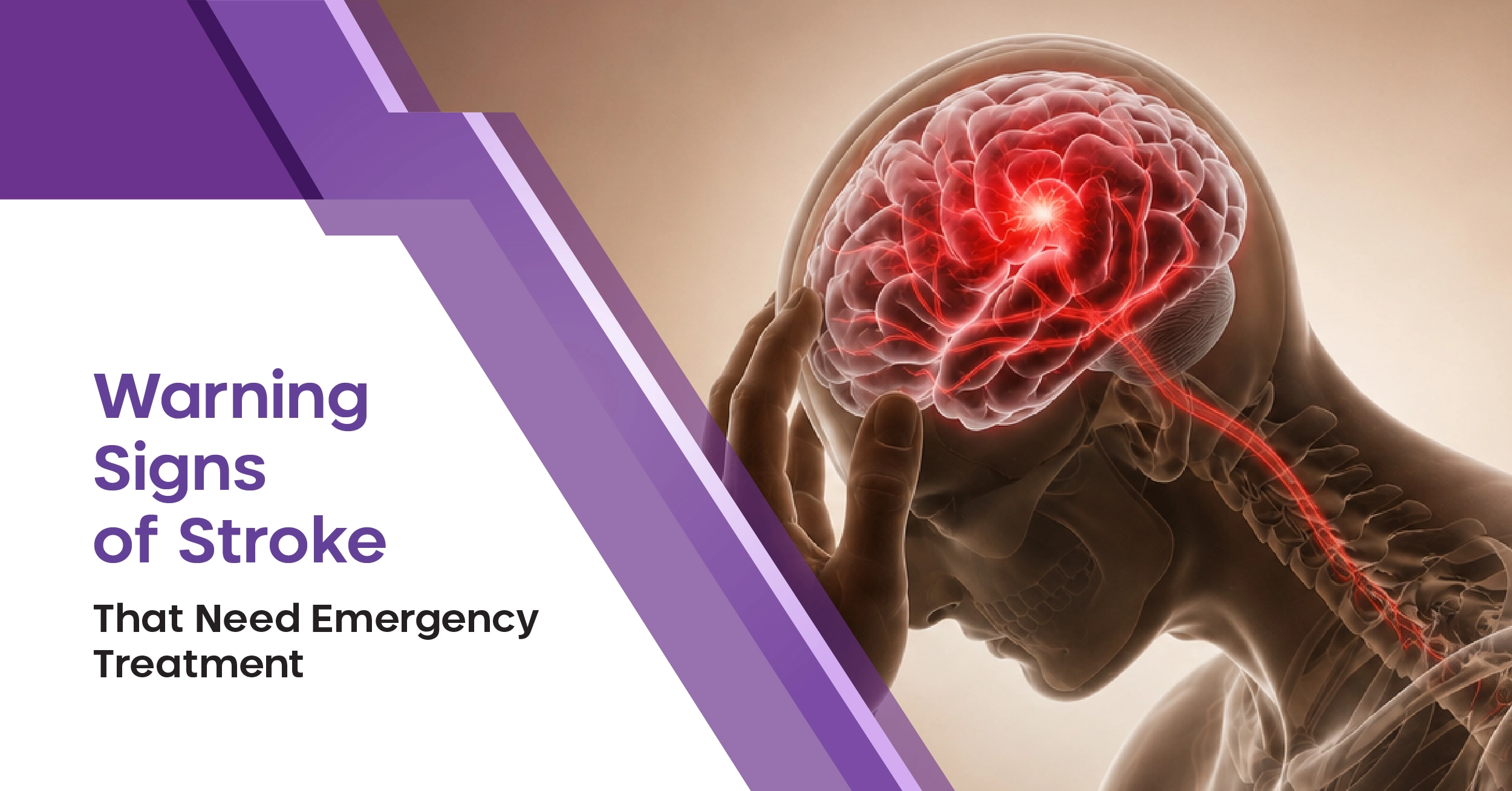 Warning Signs of Stroke That Need Emergency Treatment